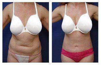 Mini Tummy Tuck — #SS068 Mini Tummy Tuck — #SS068