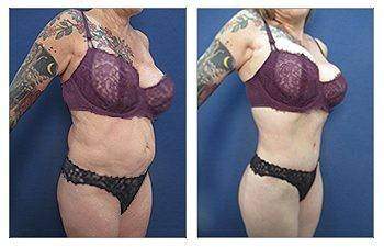 Tummy Tuck — #SS051 Tummy Tuck — #SS051