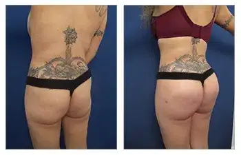 Buttock Implants — #SS136 Buttock Implants — #SS136