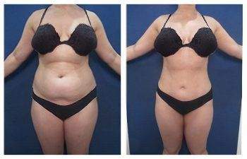 Mini Tummy Tuck + Breast Surgery — #SS078 Mini Tummy Tuck + Breast Surgery — #SS078
