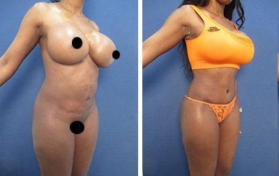 Flanks Lipo Flanks Lipo