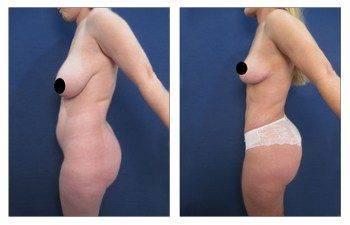 Vaser Lipo Vaser Lipo