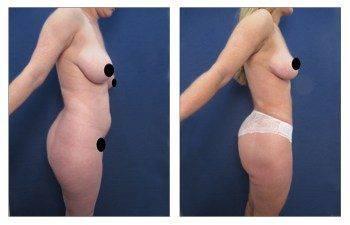 Vaser Lipo - High Definition Liposuction Results Vaser Lipo - High Definition Liposuction Results