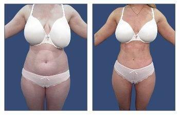 High Definition Liposuction Results High Definition Liposuction Results