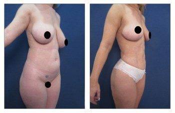 Vaser Lipo - High Definition Liposuction Results Vaser Lipo - High Definition Liposuction Results