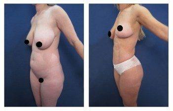 High Definition Liposuction Results, CPSI High Definition Liposuction Results, CPSI
