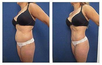 Tummy tuck before and after liposuction in Newport Beach. Tummy tuck before and after liposuction in Newport Beach.