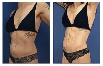 HD Liposuction — #SS097 HD Liposuction — #SS097