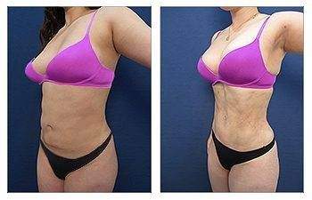 HD Liposuction — #SS038 HD Liposuction — #SS038