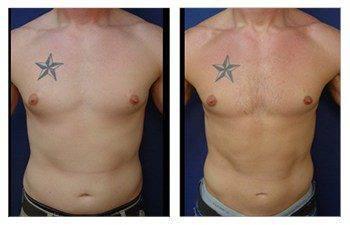 Gynecomastia Gynecomastia