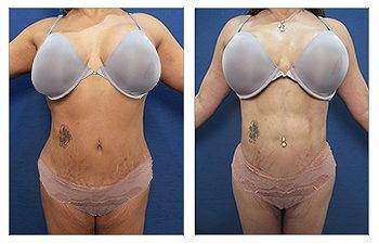 HD Liposuction + Abdominal Etching — #SS092 HD Liposuction + Abdominal Etching — #SS092