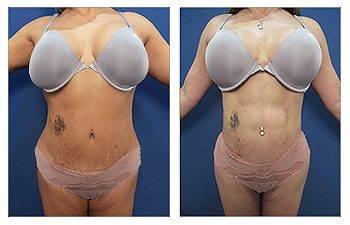 Laser Lipo vs VASER Lipo