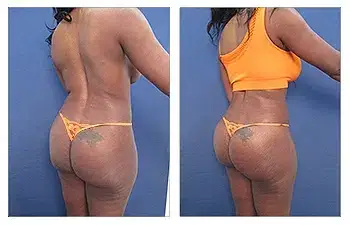 HD Liposuction + BBL — #SS124 HD Liposuction + BBL — #SS124