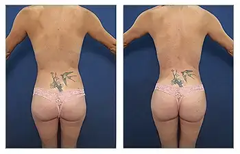 HD Liposuction + Fat Transfer — #SS132 HD Liposuction + Fat Transfer — #SS132