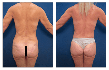Tummy tuck before and after with BBL revision. Tummy tuck before and after with BBL revision.