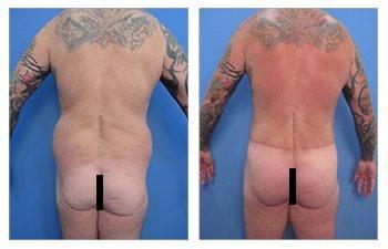 Tummy tuck and BBL surgery before and after. Tummy tuck and BBL surgery before and after.