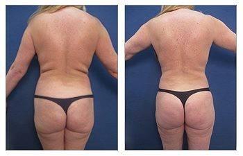 Increase in Brazilian Buttock Lifts in California Increase in Brazilian Buttock Lifts in California