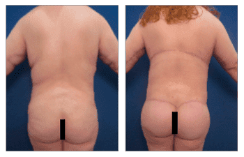 BBL revision using lateral thigh and buttock lift BBL revision using lateral thigh and buttock lift