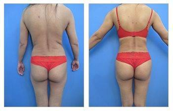 What Is The Skinny Brazilian Buttock Lift What Is The Skinny Brazilian Buttock Lift