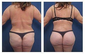 Butt Implants VS BBL With Fat Transfer Butt Implants VS BBL With Fat Transfer