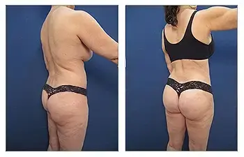 Brazilian Buttock Lift San Diego Brazilian Buttock Lift San Diego