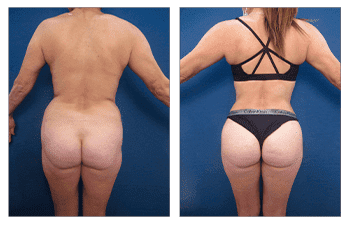 A woman's butt before and after tummy tuck surgery, emphasizing BBL transformation. A woman's butt before and after tummy tuck surgery, emphasizing BBL transformation.