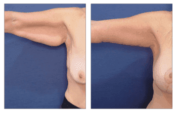 brachioplasty patient 5 back left view, Arm Lift Surgery brachioplasty patient 5 back left view, Arm Lift Surgery