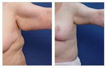 ARM LIFT SURGERY ARM LIFT SURGERY