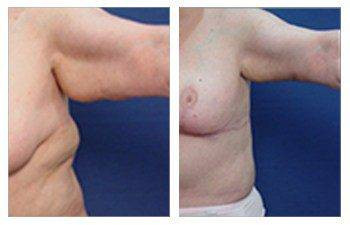 Arm Lift — #SS271 Arm Lift — #SS271