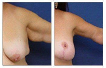 brachioplasty surgery left arm view brachioplasty surgery left arm view