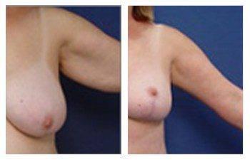 High Definition Arm Contouring, ARM LIFT SURGERY High Definition Arm Contouring, ARM LIFT SURGERY