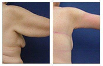 orange county brachioplasty newport beach patient 9 arms orange county brachioplasty newport beach patient 9 arms