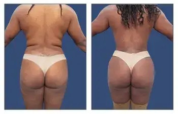 HD Liposuction + BBL — #SS010 HD Liposuction + BBL — #SS010