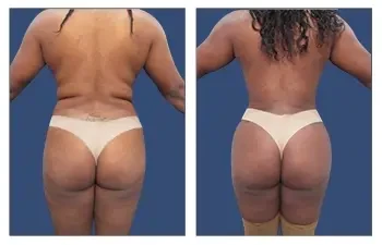 HD Liposuction + BBL — #SS010 HD Liposuction + BBL — #SS010