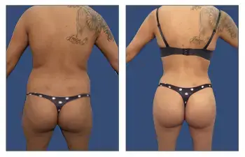 HD Liposuction + BBL — #SS044 HD Liposuction + BBL — #SS044