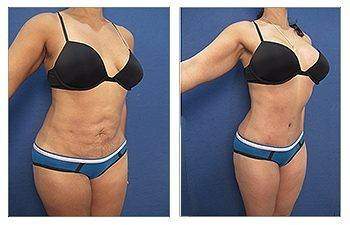 Liposuction — #SS023 Liposuction — #SS023