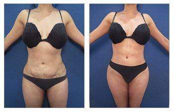 HD Lipo 360 — #SS021 HD Lipo 360 — #SS021
