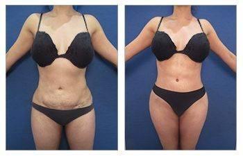 How Can I Have Painless 360 Lipo?