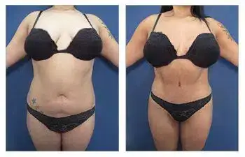 Tummy Tuck + HD Liposuction — #SS016 Tummy Tuck + HD Liposuction — #SS016