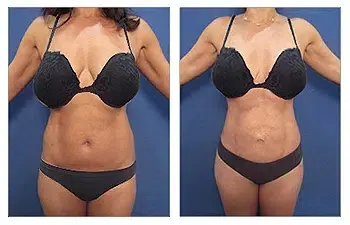 Tummy Tuck Newport Beach Tummy Tuck Newport Beach