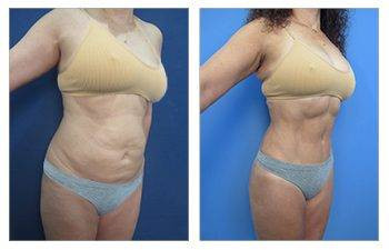 HD Lipo 360 — #SS002 HD Lipo 360 — #SS002