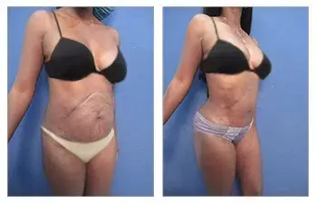 Tummy tuck before and after with liposuction recovery. Tummy tuck before and after with liposuction recovery.