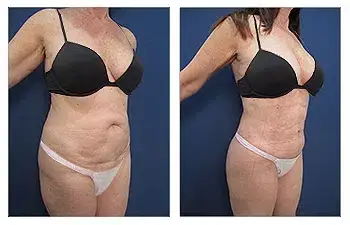 HD Liposuction — #SS025 HD Liposuction — #SS025