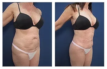 HD Liposuction — #SS025 HD Liposuction — #SS025