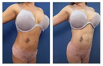 Achieve a more sculpted abdomen with abdominal etching before and after undergoing a mini tummy tuck. Achieve a more sculpted abdomen with abdominal etching before and after undergoing a mini tummy tuck.