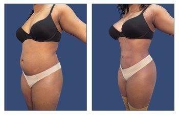 Before and after pictures showcasing the transformation of a woman's tummy through a tummy tuck procedure. Before and after pictures showcasing the transformation of a woman's tummy through a tummy tuck procedure.