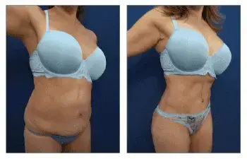 360 Tummy Tuck before and after. 360 Tummy Tuck before and after.