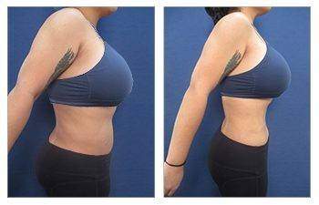 BBL + HD Liposuction — #SS035 BBL + HD Liposuction — #SS035