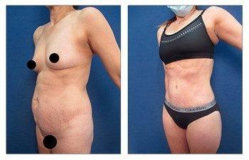 High Definition Tummy Tuck High Definition Tummy Tuck