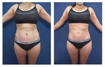 High Definition Tummy Tuck High Definition Tummy Tuck